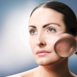 Derm Acte signe des produits peaux grasses